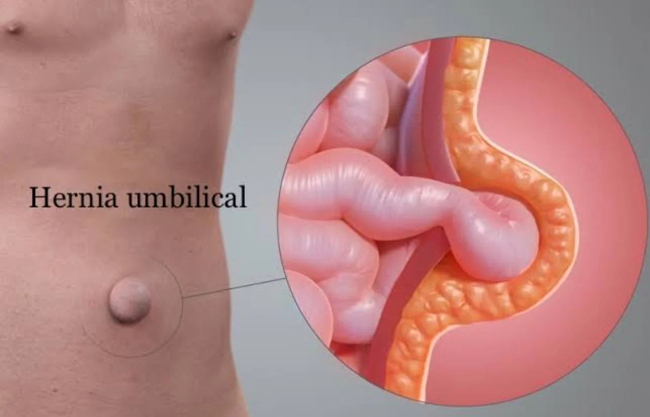 Reparación de hernias abdominales e inguinales